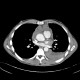 Stab wound of the thorax, perforation of the ascending aorta, bleeding into mediastinum, hemothorax: CT - Computed tomography